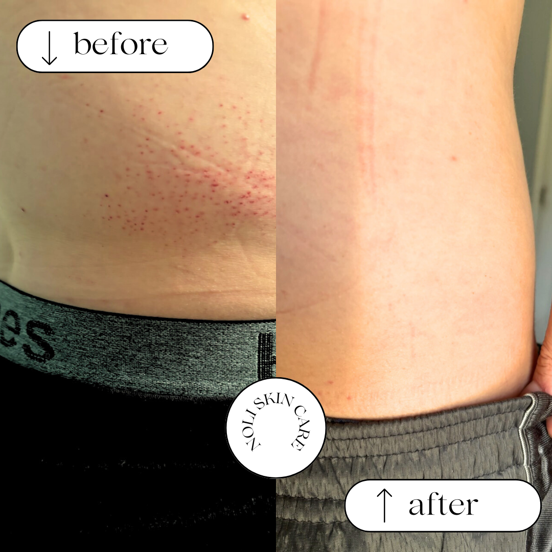 A rash would on the left showing residual irritated skin and healed skin on the right.