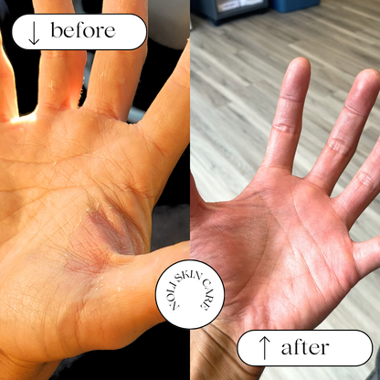 Two images of a hand, one labeled 'before' showing dry skin and another labeled 'after' showing the same hand with improved skin moisture and a label reading 'Calendula Elixir'.