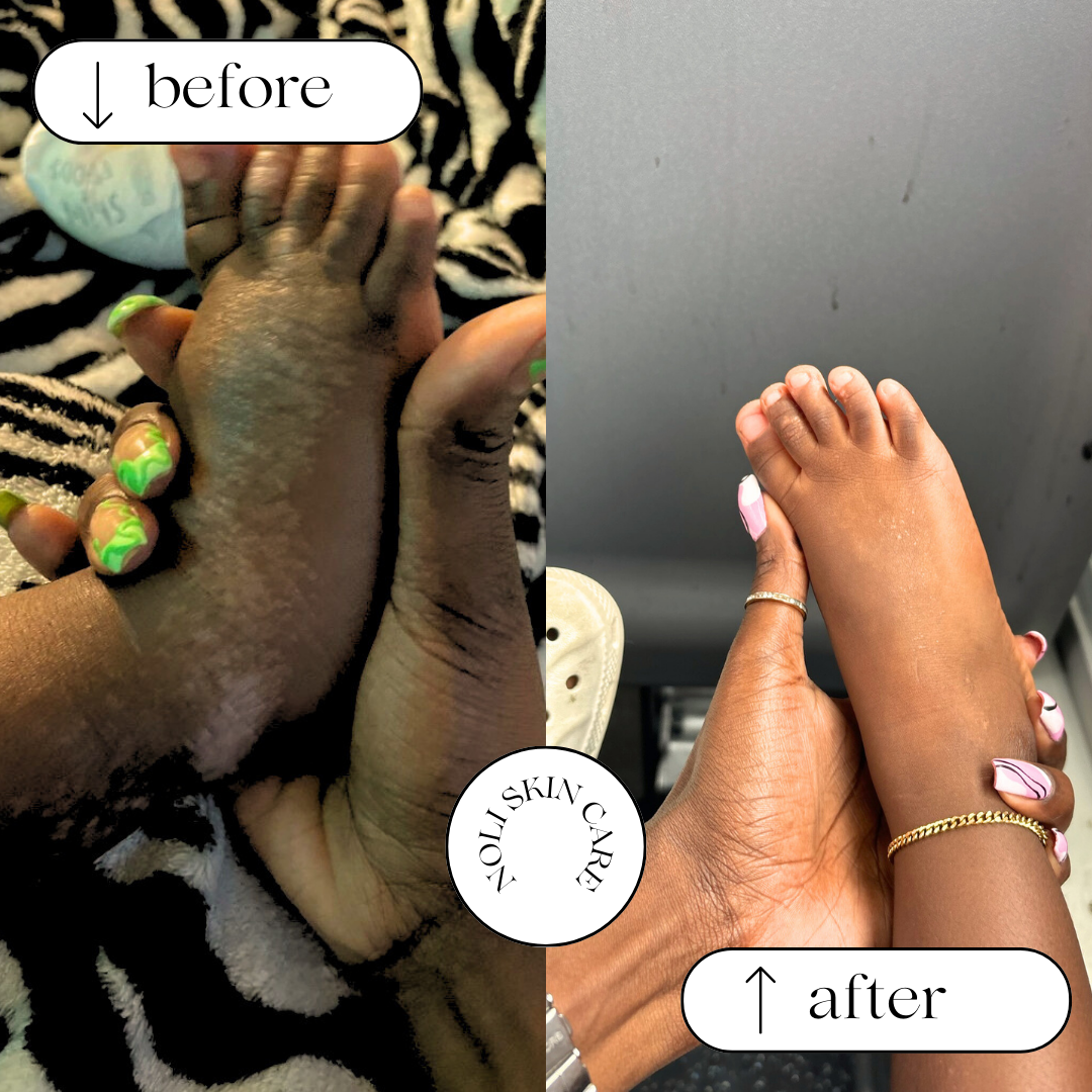 A split image showing feet before and after using Mama's All-Purpose Calendula balm, with the before image showing irritated skin and the after image showing healed and moisturized skin.